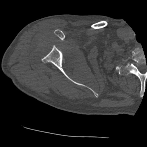 Anterior glenohumeral dislocation with Hill-Sachs lesion (Radiopaedia 62877-71249 Axial bone window 31).jpg
