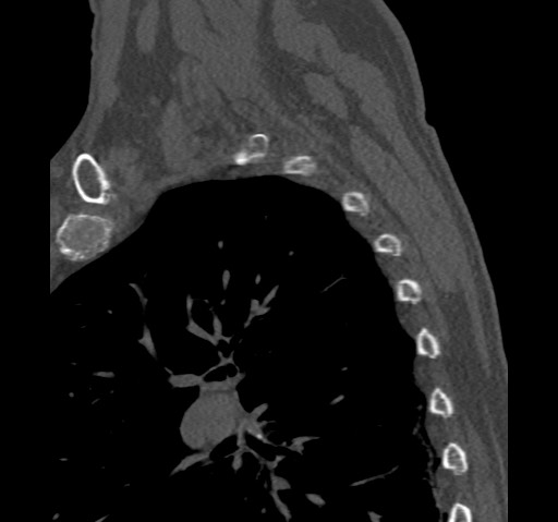 Anterior glenohumeral dislocation with Hill-Sachs lesion (Radiopaedia 62877-71249 Sagittal bone window 68).jpg