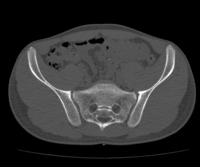 Anterior inferior iliac spine avulsion fracture (Radiopaedia 81312-94999 Axial bone window 29).jpg