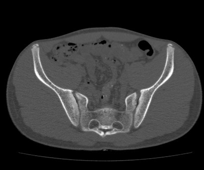 Anterior inferior iliac spine avulsion fracture (Radiopaedia 81312-94999 Axial bone window 33).jpg