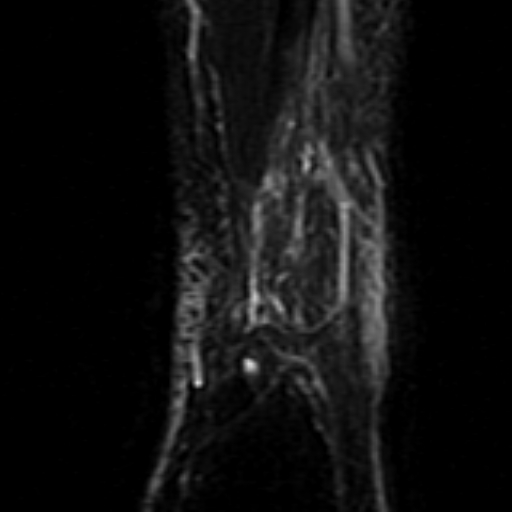 File:Anterior talofibular ligament rupture (Radiopaedia 15831-15484 Coronal STIR 23).jpg