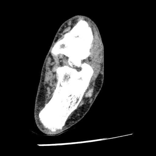 Anterior tibial artery false aneurysm (Radiopaedia 88984-105809 A 175).jpg
