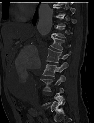 File:Anterior vertebral scalloping (abdominal aortic aneurysm) (Radiopaedia 66744-76067 Sagittal bone window 14).jpg