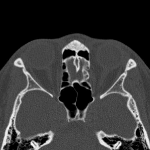 Antrochoanal polyp (Radiopaedia 33984-35202 Axial bone window 56).jpg