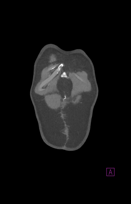 Aortectomy and axillary-bifemoral bypass (Radiopaedia 28303-28545 C 7).jpg