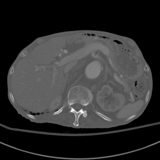 Aortic aneurysm with spinal destruction (Radiopaedia 42301-45410 Axial bone window 25).jpg
