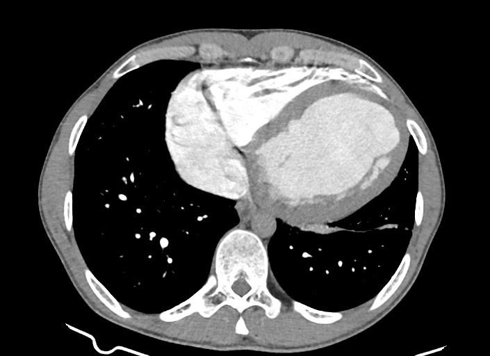 File:Aortic coarctation with aneurysm (Radiopaedia 74818-85828 A 69).jpg