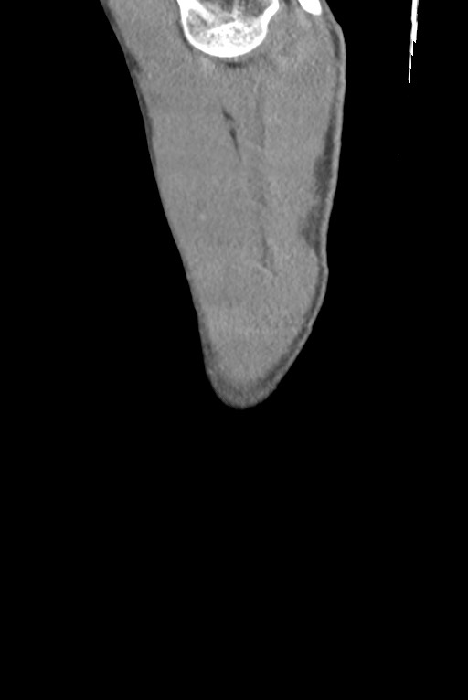 Aortic coarctation with aneurysm (Radiopaedia 74818-85828 B 2).jpg