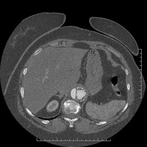 File:Aortic dissection- Stanford A (Radiopaedia 35729-37268 B 29).jpg