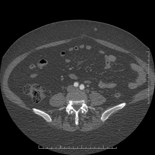 File:Aortic dissection- Stanford A (Radiopaedia 35729-37268 C 39).jpg