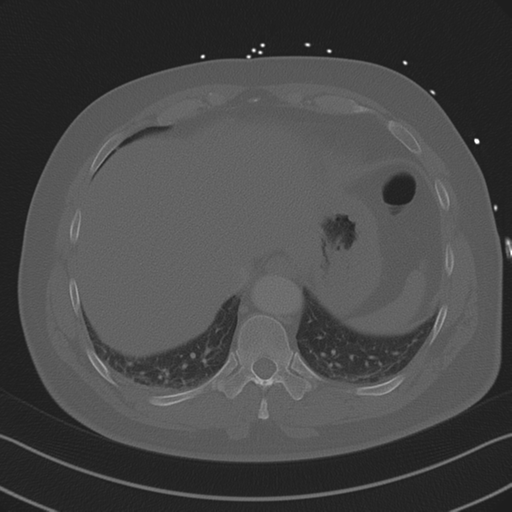 Aortic dissection (Radiopaedia 50763-56234 Axial bone window 84).png