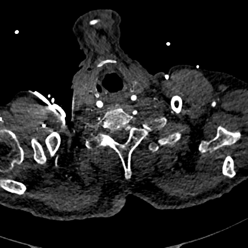 File:Aortic dissection - DeBakey type II (Radiopaedia 64302-73082 A 3).png