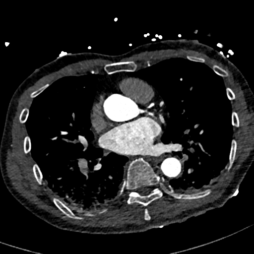 Aortic dissection - DeBakey type II (Radiopaedia 64302-73082 A 51).png