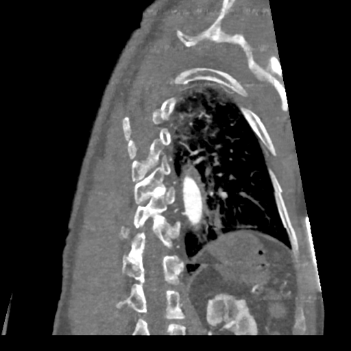 File:Aortic dissection - DeBakey type II (Radiopaedia 64302-73082 D 5).png