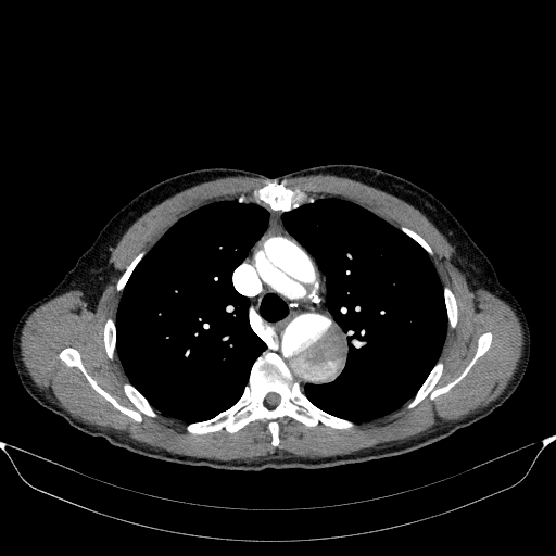 File:Aortic dissection - Stanford type A (Radiopaedia 83418-98500 A 23).jpg
