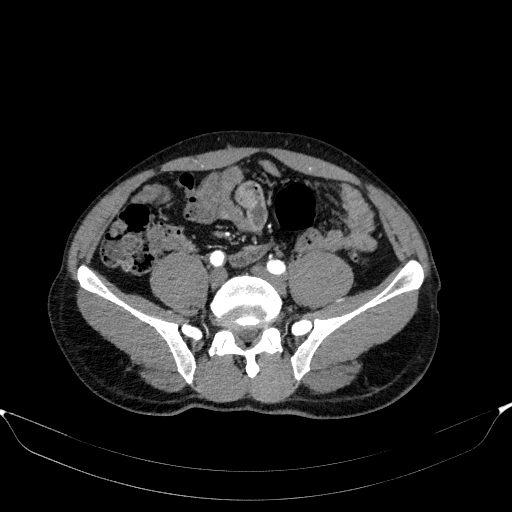 Aortic dissection - Stanford type A (Radiopaedia 83418-98500 A 97).jpg
