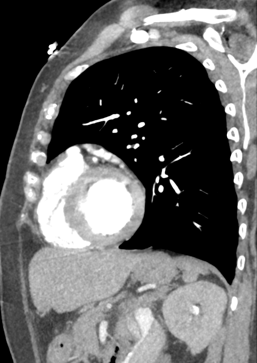 Aortic dissection - Stanford type B (Radiopaedia 50171-55512 C 13).png