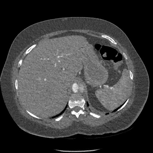 Aortic dissection - Stanford type B (Radiopaedia 88281-104910 A 92).jpg