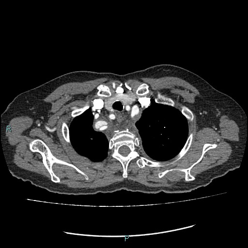 File:Aortic dissection extended to lusory artery (Radiopaedia 43686-47136 B 2).jpg