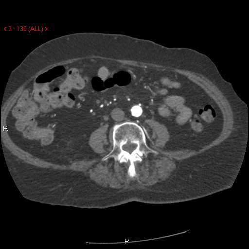 Aortic intramural hematoma (Radiopaedia 27746-28001 A 130).jpg