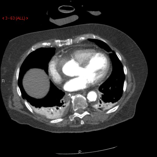 Aortic intramural hematoma (Radiopaedia 27746-28001 A 63).jpg