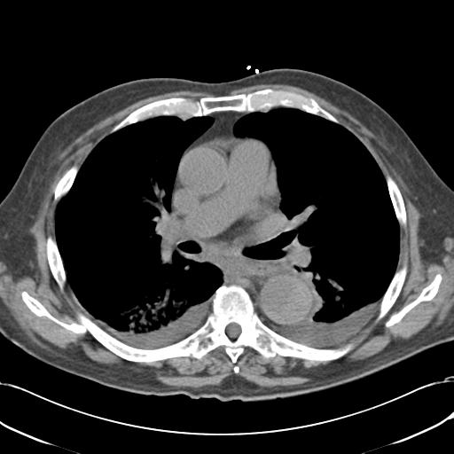 Aortic intramural hematoma (Radiopaedia 34260-35540 Axial non-contrast 30).png