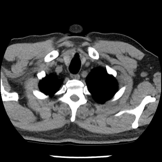 File:Aortic intramural hematoma (type B) (Radiopaedia 79323-92387 Axial non-contrast 2).jpg