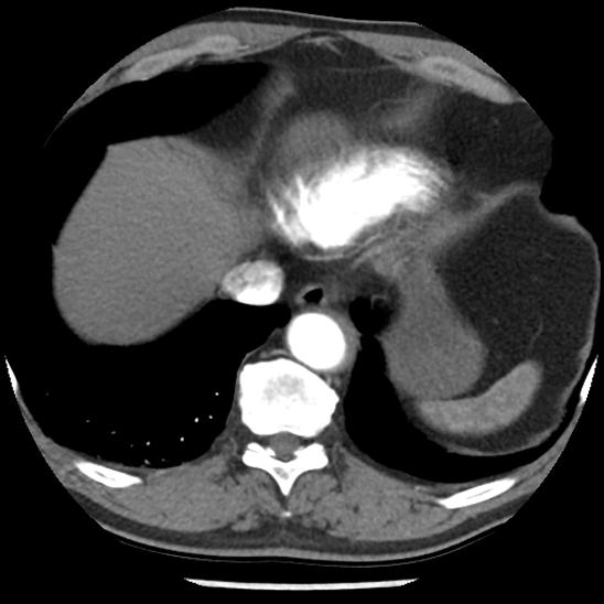 Aortic intramural hematoma (type B) (Radiopaedia 79323-92387 B 45).jpg