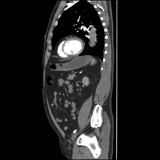 Aortic intramural hematoma (type B) (Radiopaedia 79323-92387 H 37).jpg