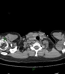 Aortic valve endocarditis (Radiopaedia 87209-103485 Axial non-contrast 6).jpg