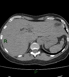 Aortic valve endocarditis (Radiopaedia 87209-103485 Axial non-contrast 90).jpg