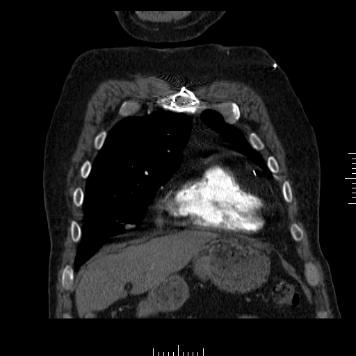 File:Aorto-coronary bypass graft aneurysms (Radiopaedia 40562-43157 B 8).png