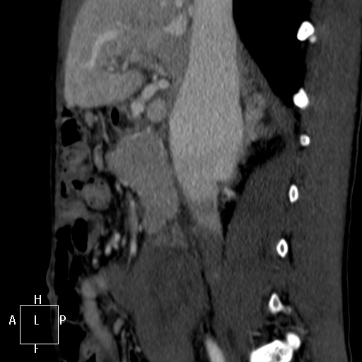 Aorto-left renal vein fistula (Radiopaedia 45534-49628 C 19).jpg