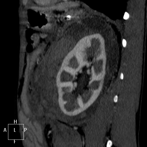 File:Aorto-left renal vein fistula (Radiopaedia 45534-49628 C 54).jpg