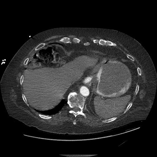 Aortoesophageal fistula with endovascular repair (Radiopaedia 73781-84592 Axial C+ CTPA 146).jpg