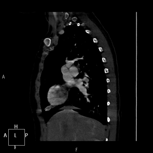 File:Aortopulmonary septal defect (Radiopaedia 41990-45013 Sagittal C+ CTPA 41).jpg