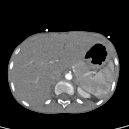 File:Aortopulmonary window, interrupted aortic arch and large PDA giving the descending aorta (Radiopaedia 35573-37074 B 94).jpg