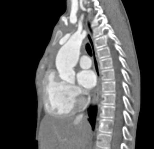 File:Aortopulmonary window, interrupted aortic arch and large PDA giving the descending aorta (Radiopaedia 35573-37074 C 16).jpg