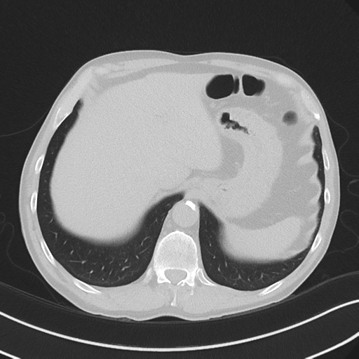 Apical pulmonary metastasis (Radiopaedia 46338-50754 Axial non-contrast 56).png