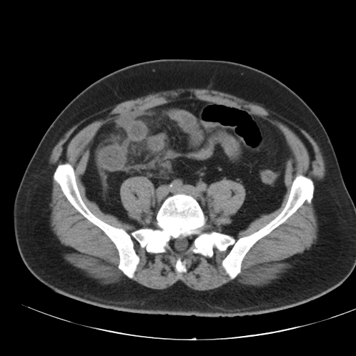 Appendicitis and giant appendicolith (Radiopaedia 80251-93588 Axial non-contrast 40).jpg