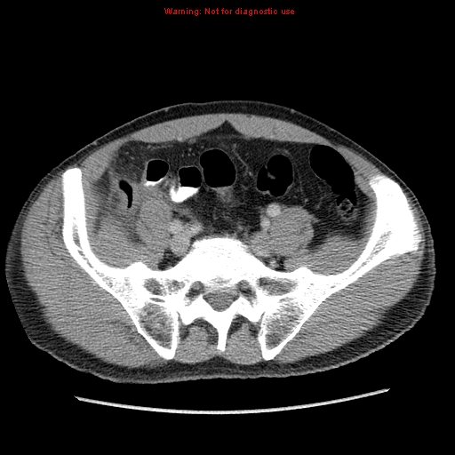 File:Appendicitis and renal cell carcinoma (Radiopaedia 17063-16760 A 43).jpg