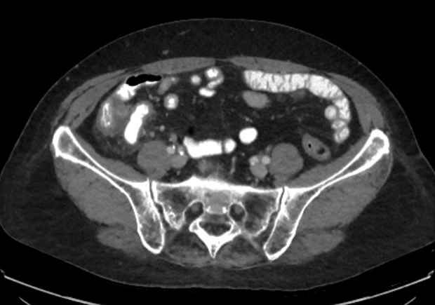 File:Appendicitis due to chicken fibula (Radiopaedia 74314-85198 A 21).jpg