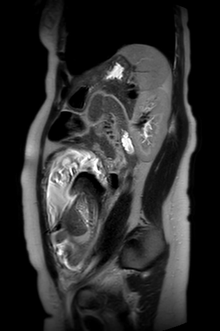 Appendicitis in gravida (MRI) (Radiopaedia 89433-106395 Sagittal T2 22).jpg