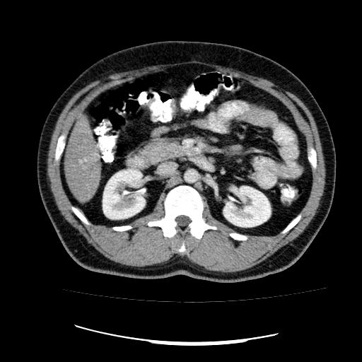 File:Appendicitis with diverticulosis (Radiopaedia 47693-52383 Axial C+ 56).jpg