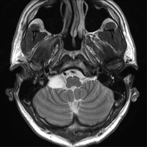 File:Arachnoid cyst - cerebellopontine angle (Radiopaedia 59689-67083 Axial T2 10).png
