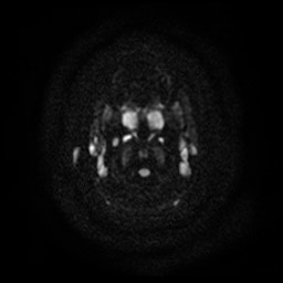 Arachnoid cyst - middle cranial fossa (Radiopaedia 86780-102938 Axial DWI 29).jpg