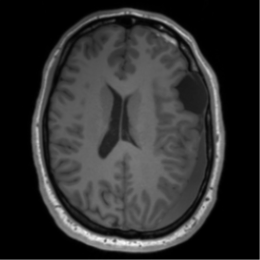 File:Arachnoid cyst with subdural hematoma (Radiopaedia 85892-101743 Axial T1 54).png