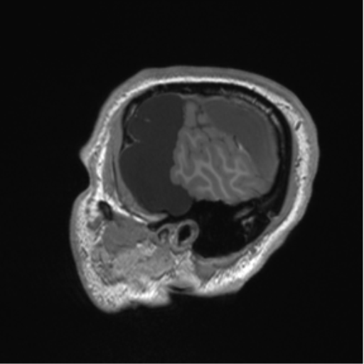 Arachnoid cyst with subdural hematoma (Radiopaedia 85892-101743 Sagittal T1 15).png