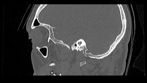 File:Arcuate foramen (Radiopaedia 89833-106944 Sagittal bone window 122).jpg