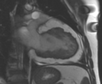 Arrhythmogenic right ventricular cardiomyopathy (Radiopaedia 69431-79307 2ch cine 31).jpg